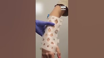 Innovative Stabilizer for Broken Bones.. #innovation #treatment