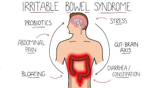 Irritable Bowel Syndrome (IBS)  Including Symptoms, Criteria & Treatment!