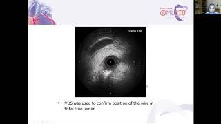 CTO PCI Antegrade Dissection re-entry in Covid-19 Pandemic