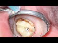Evergreen Endodontics  - Retreatment of a Root Canal Tooth #15 #issaquah #rootcanal #retreatment