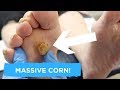 MASSIVE CORN TREATMENT