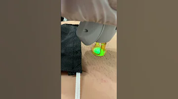 Laser Hair Removal At SEV DISCLAIMER This Client Was Unshaven Due To Video Purposes 