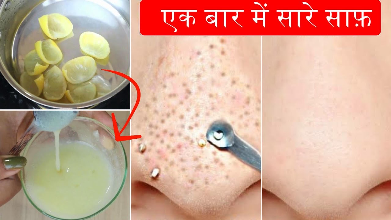 Overnight Blackheads Clearing Lemon Gel-रात में लगाये Blackhead Whiteheads पर सुबह मिलेगी Clear Skin