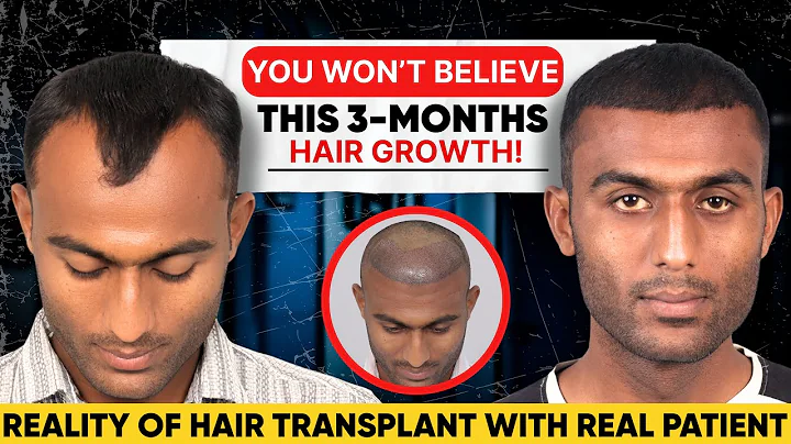 3 Months Post Hair transplant (HX-RZNC) | Real Patient Experience