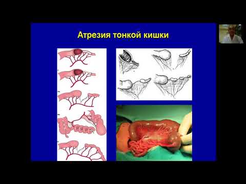 Врожденная кишечная непроходимость у детей