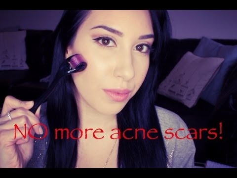 How To Get Rid Of Acne Scarring AT HOME! Before + After Pics + DEMO (Banish Acne Scars Review)