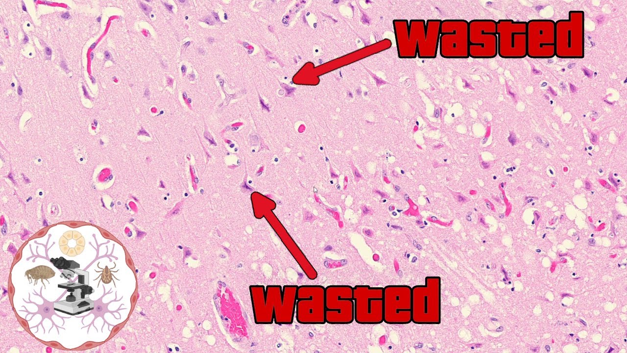 Полное разрушение ядра: руководство по некрозу в гистопатологии