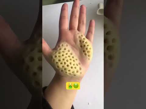 فوبيا الثقوب    