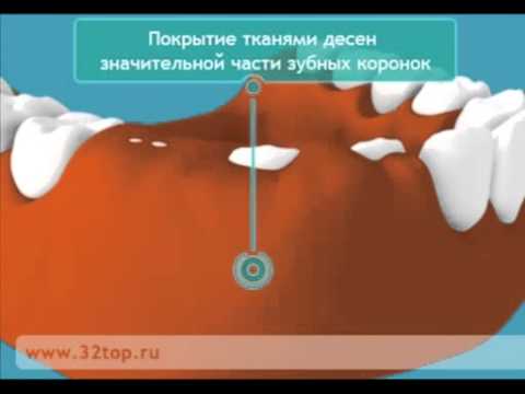 Гиперплазия дёсен - набухание десен и увеличение размера десен.