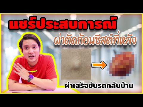 แชร์ประสบการณ์ [ผ่าตัด] ก้อนซีสต์ที่หลัง ผ่าเสร็จขับรถกลับบ้านได้เลย