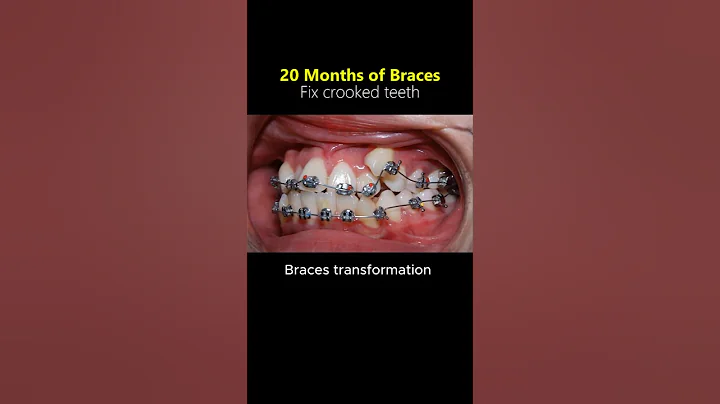 Braces journey: Straightening crooked teeth in 20 months #orthodontist #braces #dentist