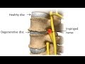 Degenerative Disc Disease: Progression, Symptoms, and What to Do About It.