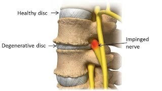 Degenerative Disc Disease: Progression, Symptoms, and What to Do About It.