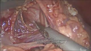 Paraesophageal hernia in a child operated by Dr Shandip Sinha, Pediatric Laparoscopic surgeon