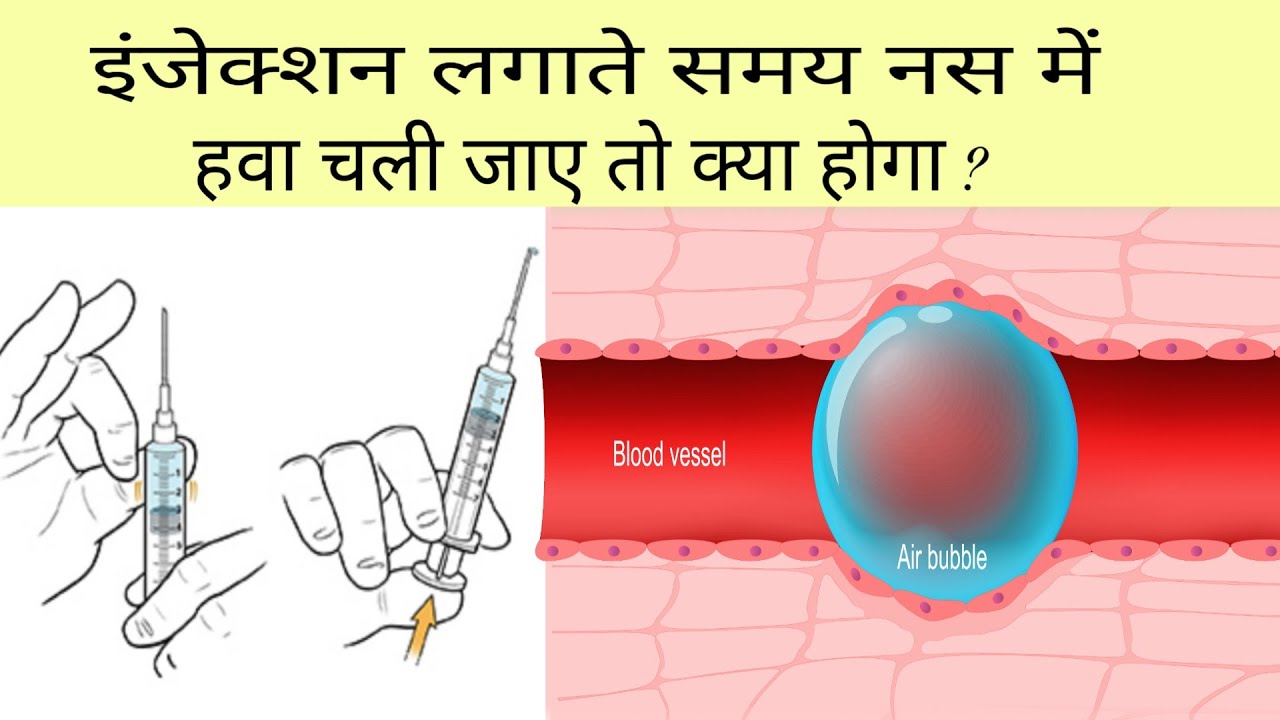 इंजेक्शन लगाते समय नस में हवा चली जाए तो क्या होगा ? डॉक्टर खाली इंजेक्शन क्यों नहीं लगाते ?
