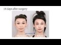 American girl experiencing plastic surgery in Korea and the result is unbelievable!