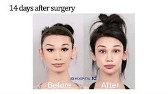 American girl experiencing plastic surgery in Korea and the result is unbelievable!