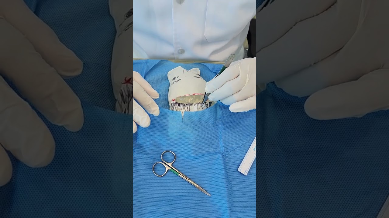 شرح عملى لعملية  تصغير الجبهة.  د. نادى صقر