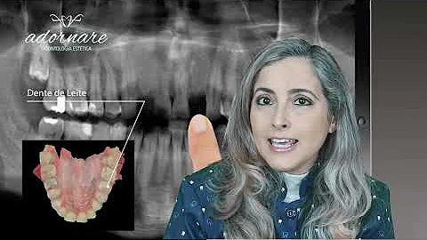Quantos dias leva para o dente de leite cair?