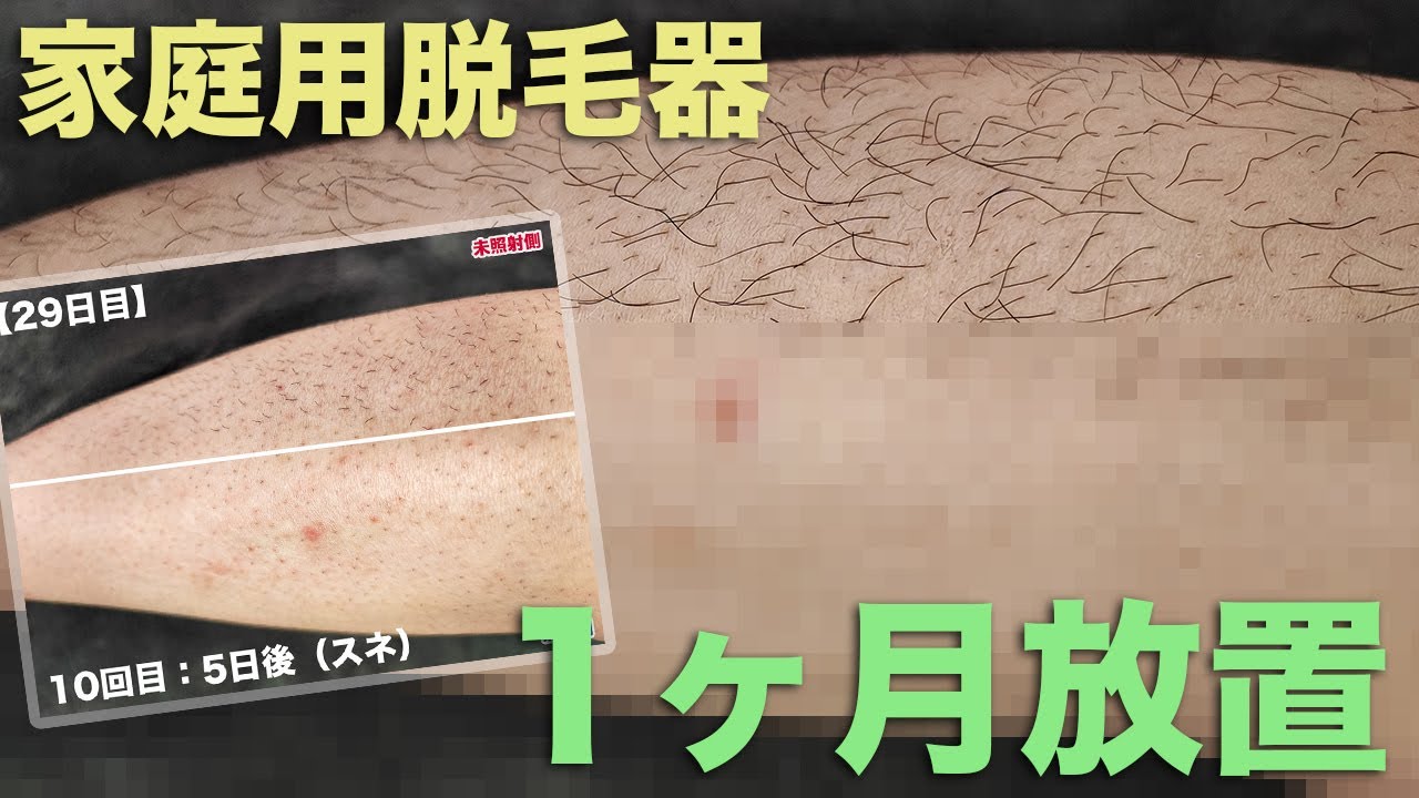Ulike Air2 光美容器検証】最後に毛をそってから1ヶ月放置した状態が 