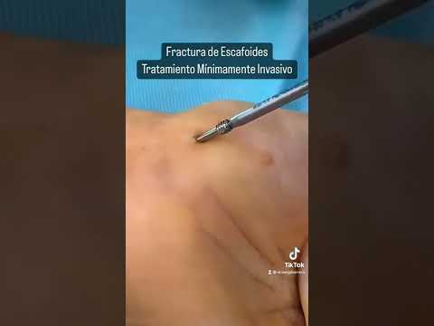 Vídeo: La fractura de l'escafoide cura?