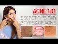 Acne 101: How to Take Care of Acne At Home (Types & Treatment) | Wishtrend
