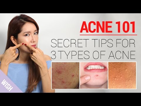 Acne : How to Take Care of Acne At Home (Types & Treatment) | Wishtrend