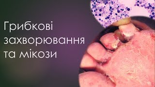 Грибкові захворювання та мікози