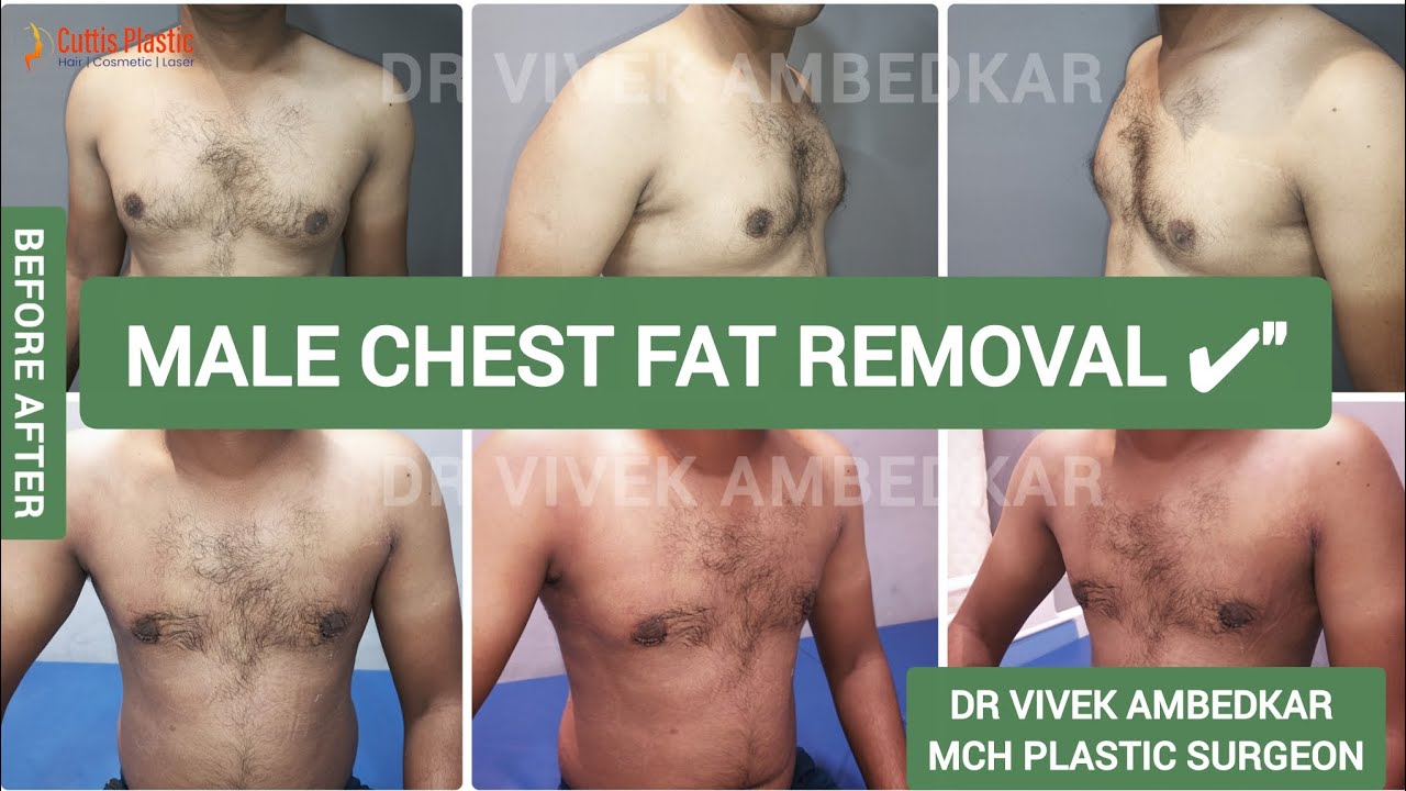 Permanent Solution for Gynecomastia | Male Chest Transformation After Gynecomastia Surgery Result 