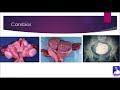 Doctor Froy - Miomatosis uterina