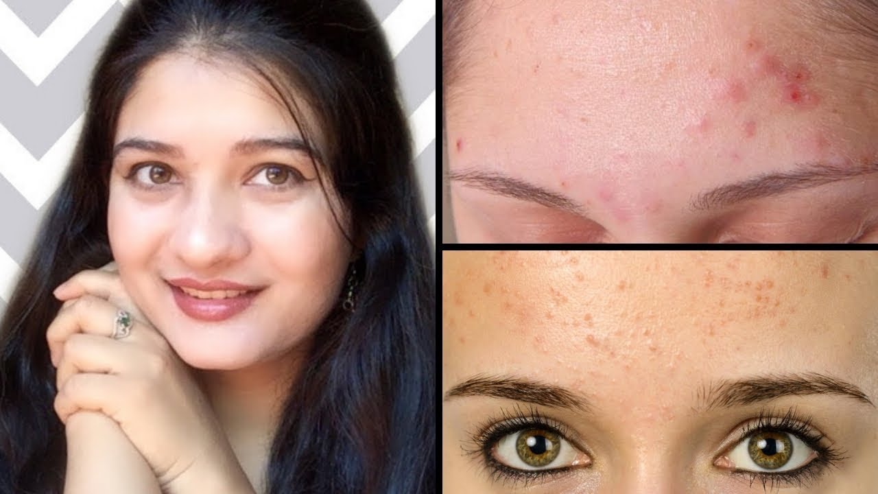 Clear tiny forehead Bumps How to get rid of Small