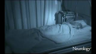 An adult patient rhythmic movement disorder