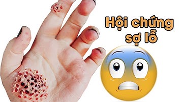 Đừng Xem Nếu Bạn Sợ - Hội Chứng Sợ Lỗ | Quà Tặng Sức Khỏe