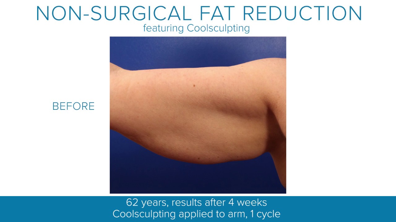 Arm Fat Reduction CoolSculpting at The CAPS Clinic Canberra 