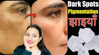 फिटकरी (Alum) से मुश्किल झाइयाँ Hyperpigmentation Melasma काले धब्बे Dark Spots का करें 100% इलाज💕