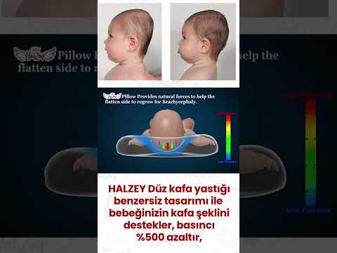 Video: Bebek sağlığı A-Z: Düz Kafa Sendromu