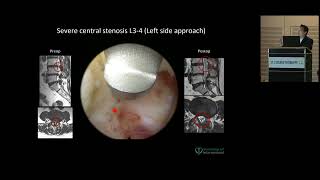 Case Presentation – Lumbar Central Canal Stenosis / RIWOspine Global Endoscopic Spine Days 2023