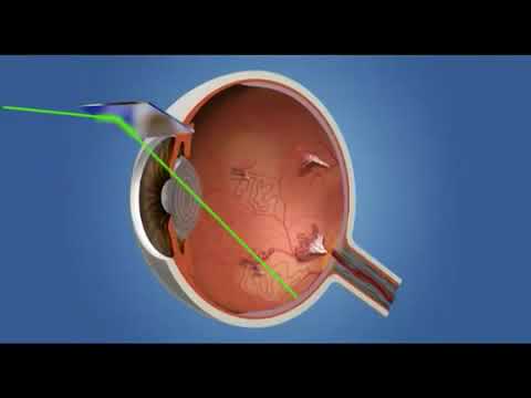 Is laser painful? What is laser for diabetic retinopathy? Advanced Retina Care