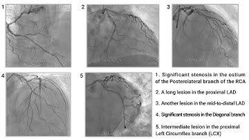 Eight FFR measurements using one TruePhysio Rx Pressure Microcatheter