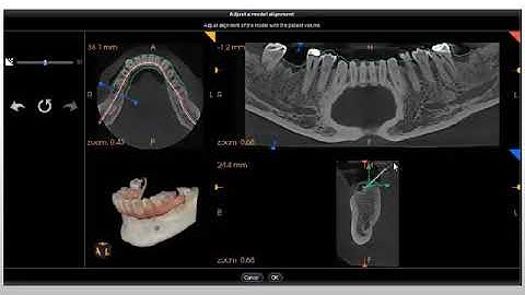 CS 3D Imaging: Prosthetic-Driven Implant Planning Workflow Recorded Class