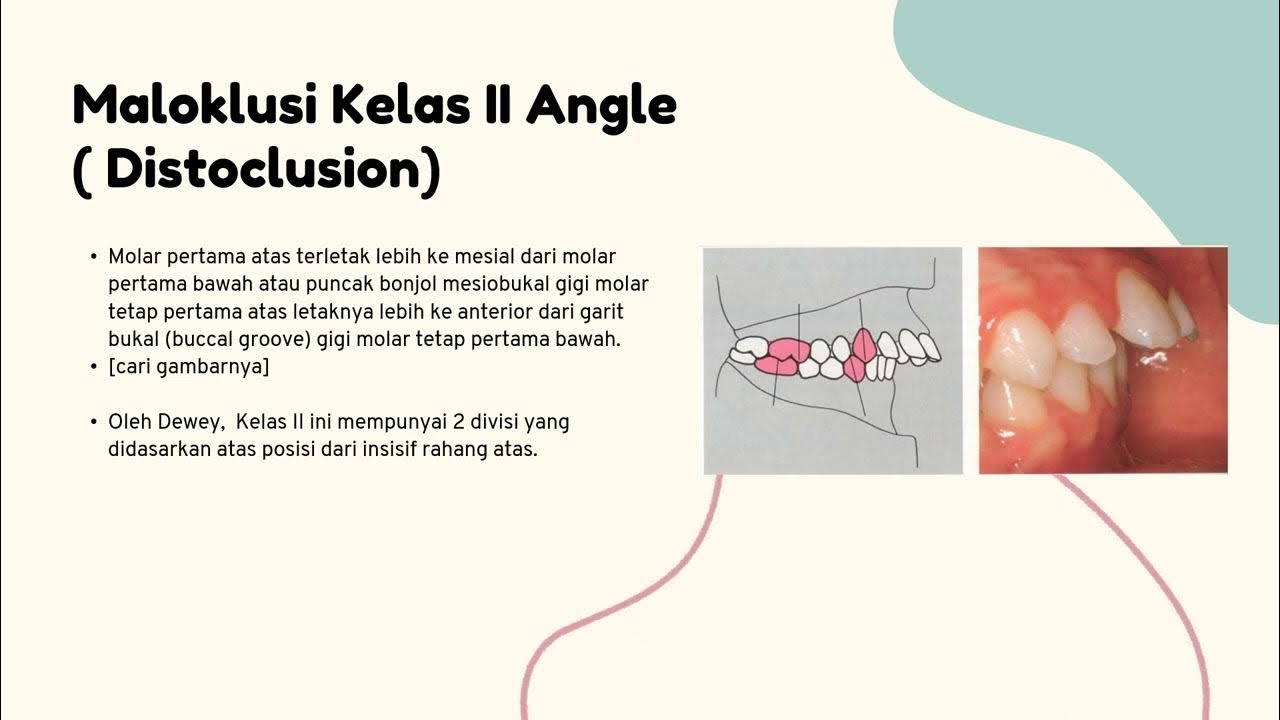 Klasifikasi Maloklusi Angle 160110210020 Hilda YouTube klasifikasi-maloklusi-angle-160110210020-hilda-youtube