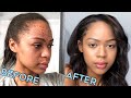 HOW I CLEARED MY ACNE & ACNE SCARS! + My Best Tips For Acne Prone Skin!