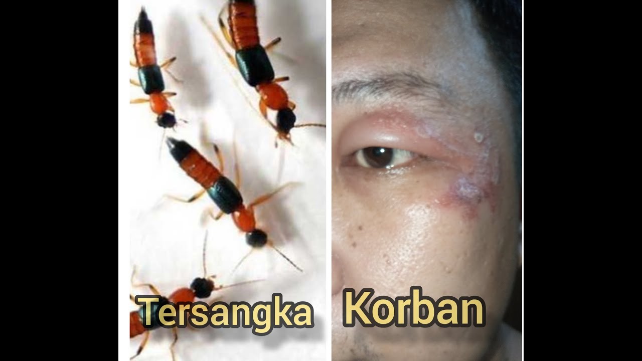 Cara menghilangkan bekas gigitan Tomcat part I