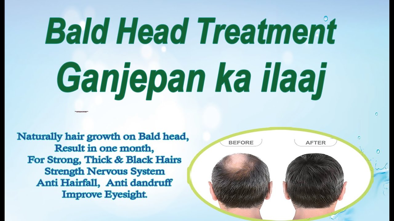 Bald Head Treatment Ganjepan ka ilaaj