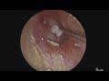 Endoscopic myringotomy with grommet insertion