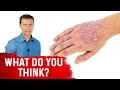 Is Psoriasis Contagious?