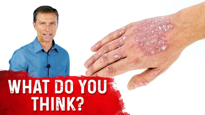 What is Psoriasis and Is Psoriasis Contagious? Explained by Dr.Berg - DayDayNews
