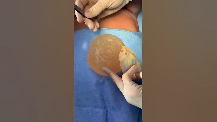 Dr. Unger Performing a Breast Revision