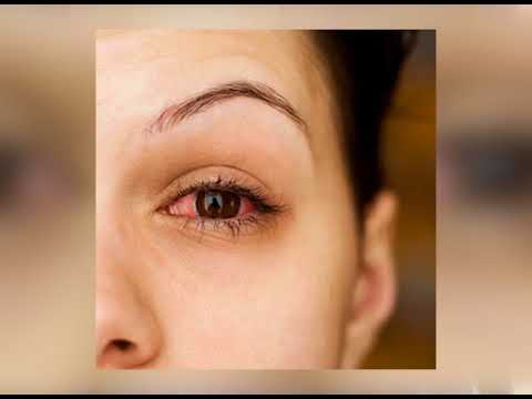 How to Avoid the Contagious ‘Pink Eye’
