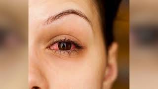 How to Avoid the Contagious ‘Pink Eye’